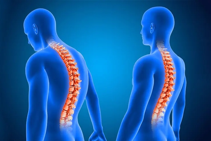 what is kyphosis